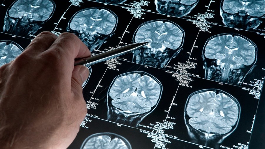 Crearon un sensor que puede identificar signos del Alzheimer hasta 17 años antes