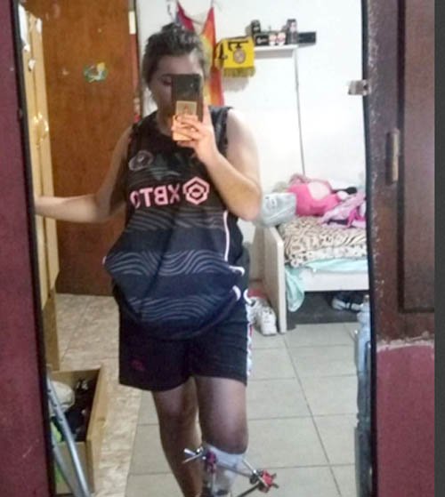 Tuvo un accidente y debe recaudar $7 millones para salvar su pierna